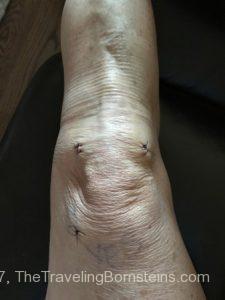 2 days post-op from knee surgery
