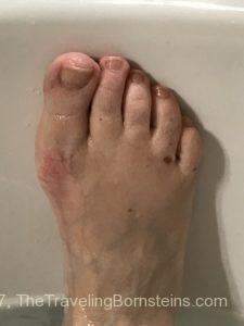 Red Discoloration at 1st Metatarsal when subjected to heat