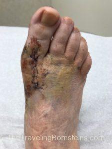 2 Weeks Post-Op from Ganglion Metatarsal Bone Cyst Surgery